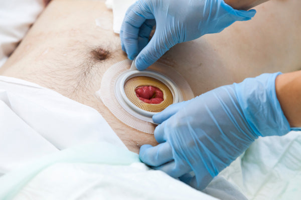 What Are the Three Major Problems Associated with Having a Stoma?