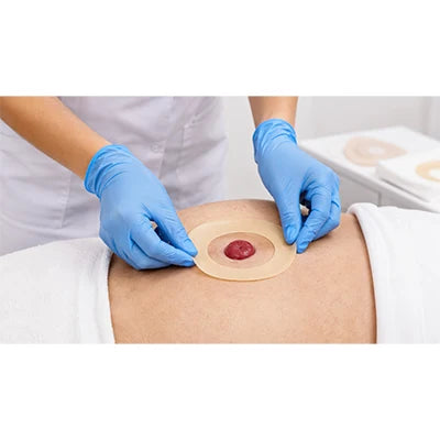 A nurse sizing a stoma