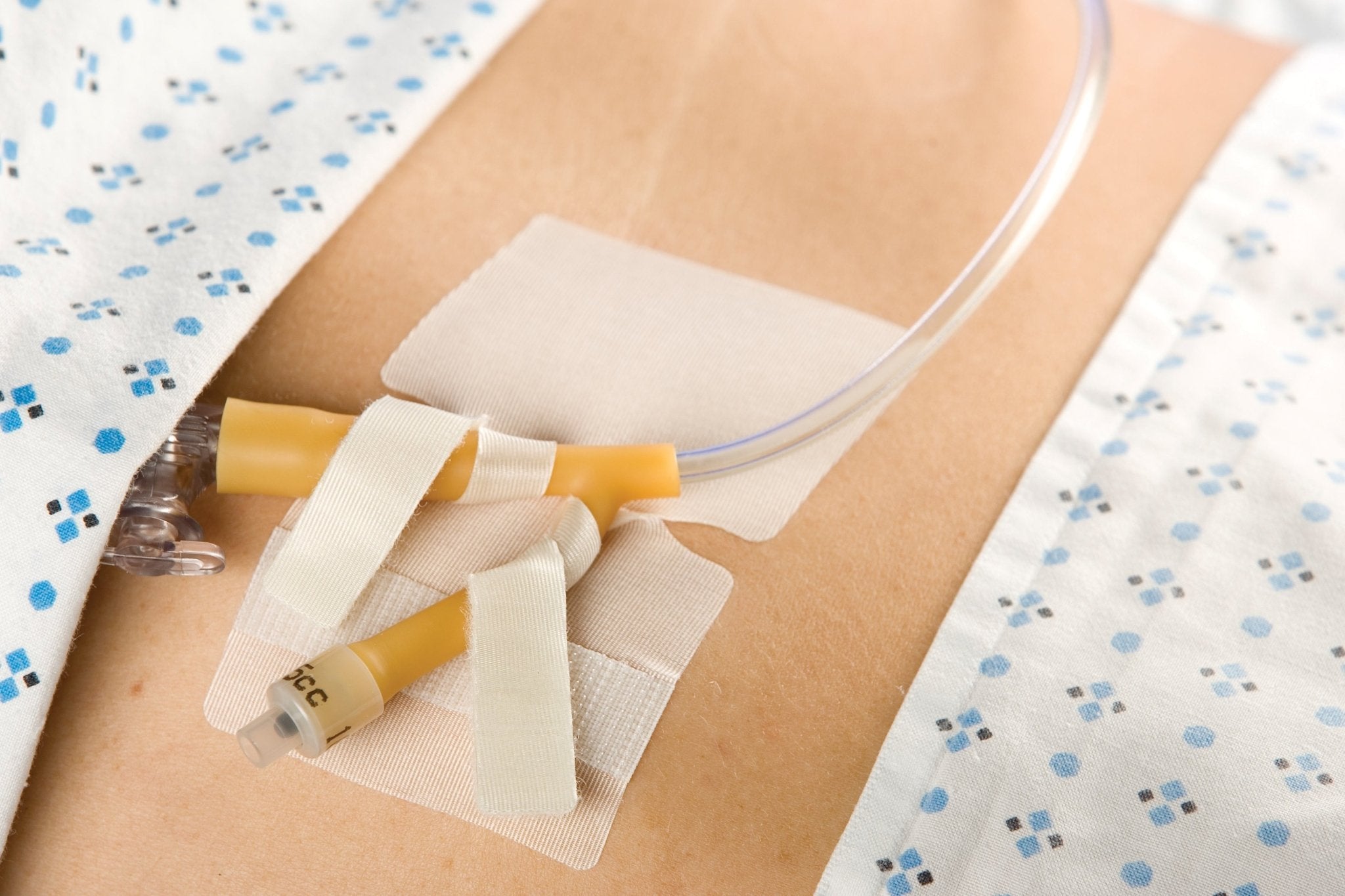 EA/1 - CATH-SECURE Dual Tab Multi-Purpose Tube Anchoring Device - Best Buy Medical Supplies