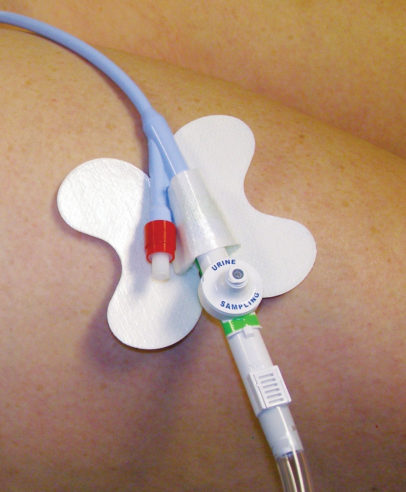 EA/1 - CATH-SECURE Plus Water-Resistant/Breathable Tube Holder - Best Buy Medical Supplies