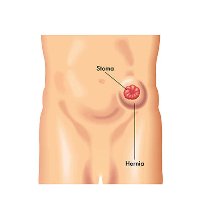 Parastomal Hernia Image