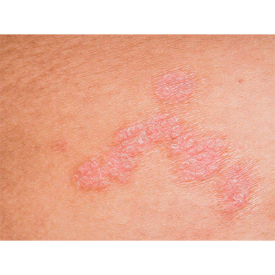 Incontinence-Associated Dermatitis (IAD): How to Recognize, Prevent, and Treat Skin Breakdown from Incontinence