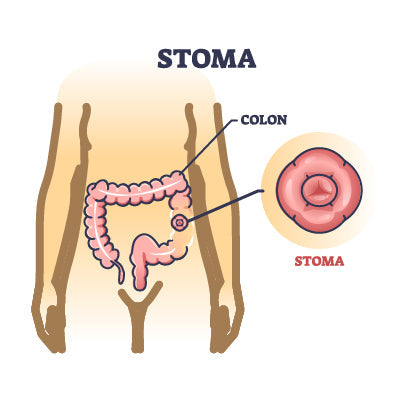 How to Heal Raw, Irritated Skin Around Your Stoma: The Powder and Barrier Method