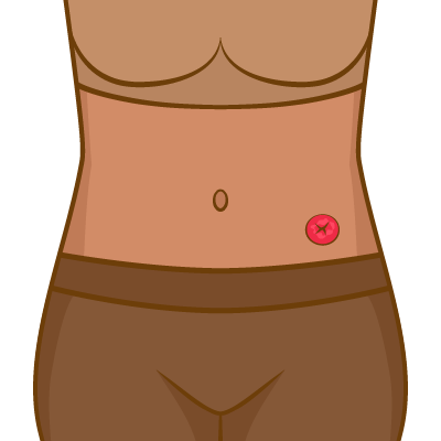 Peristomal Skin Complications: How to Identify, Treat, and Prevent Common Skin Issues Around Your Stoma
